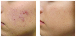 Trądzik pospolity - leczenie laserem przed i po zabiegu