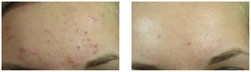 Trądzik pospolity - leczenie laserem przed i po zabiegu