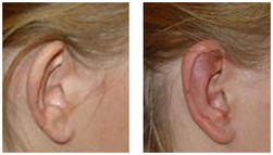 Korekcja odstających uszu przed i po zabiegu