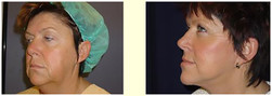 Lifting operacyjny twarzy przed i po zabiegu