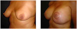 Podniesienie piersi wraz z powiększaniem implantami przed i po zabiegu