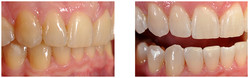 Wybielanie zębów lampą - jednowizytowe przed i po zabiegu