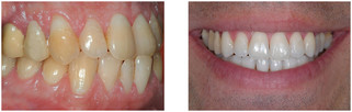 Wybielanie zębów lampą - jednowizytowe przed i po zabiegu