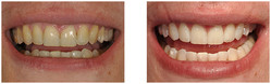 Wybielanie zębów przed i po zabiegu