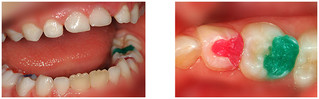 Wypełnienia w zębach mlecznych przed i po zabiegu