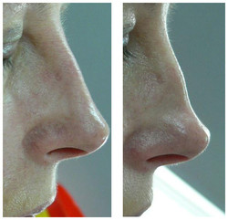 Korekta nosa kwasem hialuronowym