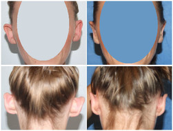Korekcja odstających uszu - przed i po zabiegu