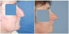 Korekcja nosa kostnego (nos garbaty) - przed i po zabiegu