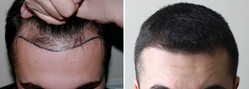 Przeszczep włosów metodą FUT - przed i po zabiegu