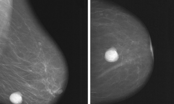 Mammografia MR w diagnostyce piersi