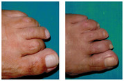 Operacja palca młoteczkowatego / młotkowatego stopy przed i po zabiegu