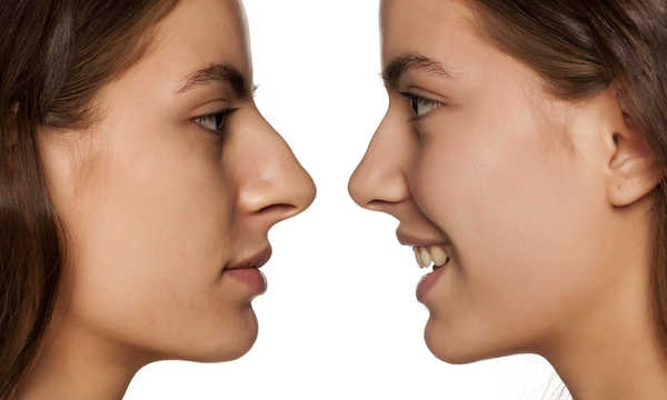 Kiedy widoczne są efekty po operacji plastycznej nosa?