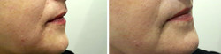 Broda - epilacja laserowa przed i po zabiegu