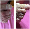 Rekonstrukcja płytki paznokcia przed i po zabiegu