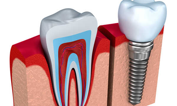 Rodzaje implantów stomatologicznych