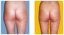 Liposukcja pośladków przed i po zabiegu