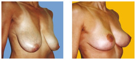 Podniesienie piersi wraz z powiększaniem implantami przed i po zabiegu