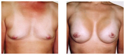 Powiększanie piersi przy operacji zmiany płci przed i po zabiegu