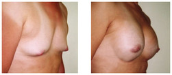 Powiększanie piersi przy operacji zmiany płci przed i po zabiegu