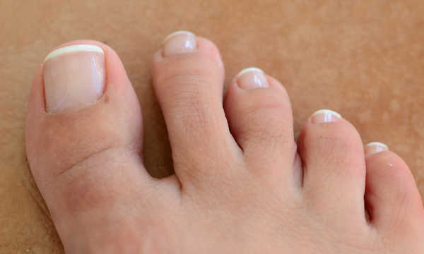 Wrastające paznokcie – leczenie za pomocą klamer drutowych metodą ortonyksji
