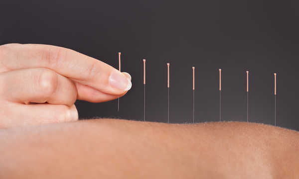 Akupunktura a leczenie porażenia nerwu twarzowego