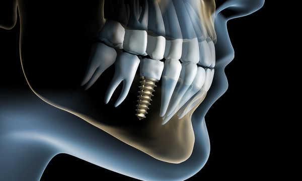 Bio-Oss - zastosowanie w zabiegach odbudowy kości