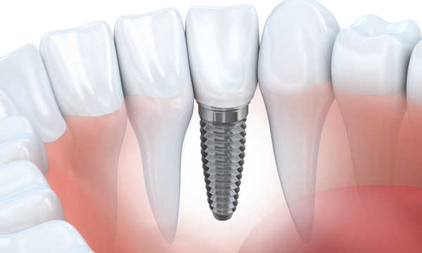 Część chirurgiczna zabiegu implantacji zęba