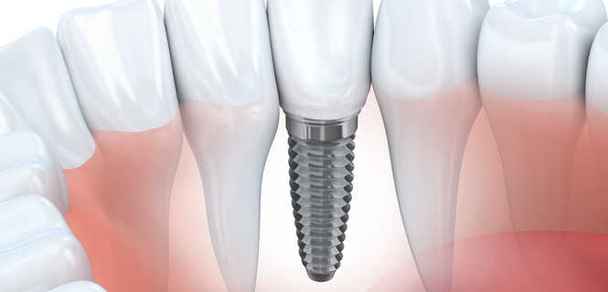 Część chirurgiczna zabiegu implantacji zęba