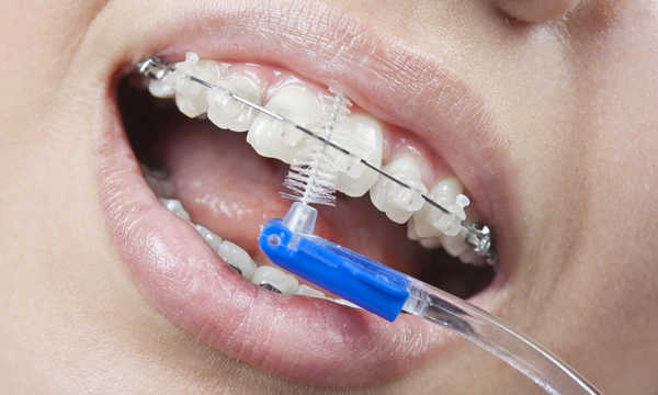 Wizyty kontrolne w trakcie leczenia ortodontycznego