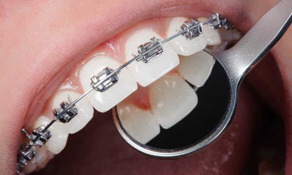 Aparat ortodontyczny a leczenie stomatologiczne