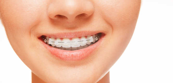Aparaty ortodontyczne stałe