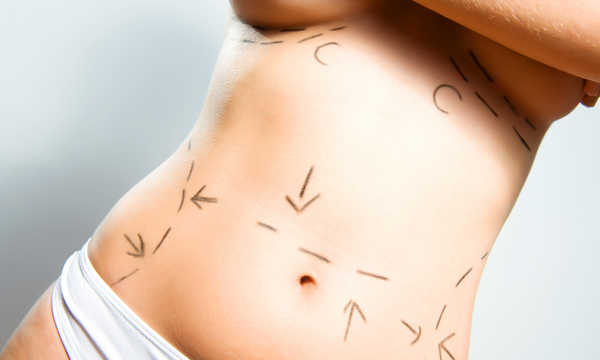 Jak długo utrzymują się efekty liposukcji?