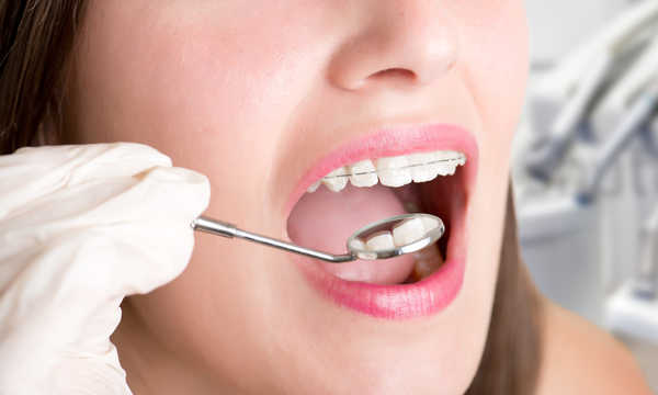 Jak długo trwa założenie aparatu ortodontycznego?