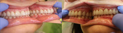 Uzębienie po leczeniu ortodontycznym
