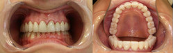Uzębienie po leczeniu ortodontycznym, mającym na celu pionizację pochylonych do luki trzonowców, zastosowano korony mosty na podbudowie z cyrkonu olicowane ceramiką dentystyczną