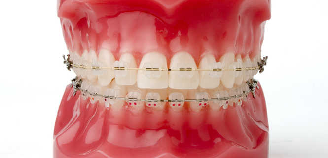 Refundacja aparatów ortodontycznych