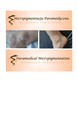 Bielactwo - pigmentacja medyczna przed i po zabiegu