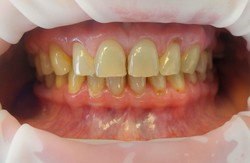 Przypadek 3. Pacjentka chciała poprawić estetykę przednich zębów. Problem stanowiły zęby przebarwione oraz nieestetyczne wypełnienia w zębach przednich. Pacjentka chciała też zamknąć przestrzenie między zębami, mało widoczne na zdjęciu.