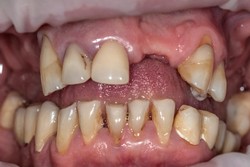 Przypadek 4. Pacjent użytkujący przez wiele lat protezy ruchome akrylowe, skarżył się na brak stabilności protez oraz brak estetyki. Problem stanowiły braki zębowe, przebarwienia zębów. Celem leczenia była poprawa estetyki zębów przednich oraz poprawa stabilizacji protezy ruchomej. 