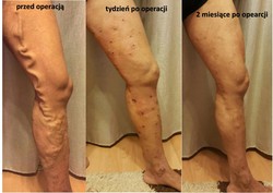 Leczenie żylaków nóg przed i po zabiegu