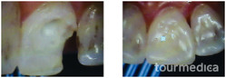 Odbudowa zęba kompozytem przed i po zabiegu