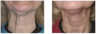 Zabiegi z użyciem botoksu przed i po zabiegu