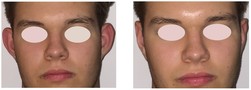 Korekcja uszu nićmi Aptos przed i po zabiegu