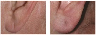 Płatki uszu - regeneracja kwasem hialuronowym przed i po zabiegu