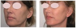 -Kwas hialuronowy(policzki, broda, kontur ust)
-Nici APTOS (lifting twarzy, szyja)
-Laser CO2 (resurfacing twarzy)
-Peeling TCA