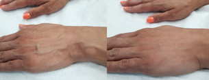Dłonie - usuwanie zmarszczek kwasem hialuronowym przed i po zabiegu