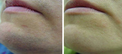 Efekt depilacji laserowej brody w klinice Bellazone