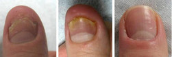 Grzybica paznokci - usuwanie laserem przed i po zabiegu