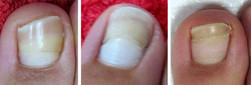 Grzybica paznokci - usuwanie laserem przed i po zabiegu