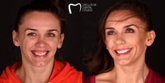 Aparat ortodontyczny przed i po zabiegu